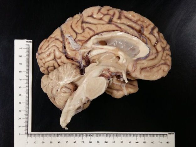 Cientistas usam ‘scan’ cerebral para descobrir mais cedo doença de Parkinson